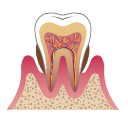 中等度の歯周病