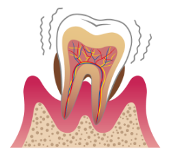 重度の歯周病